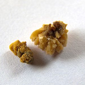 what does a kidney stone look like